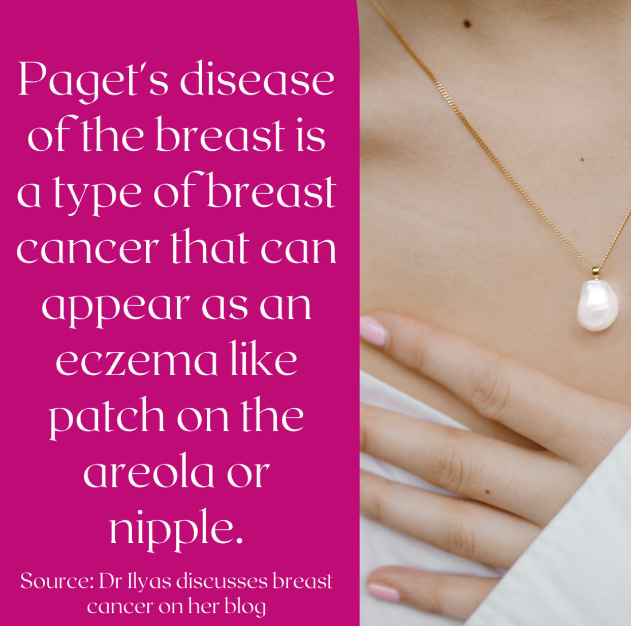 Paget's disease of the breast